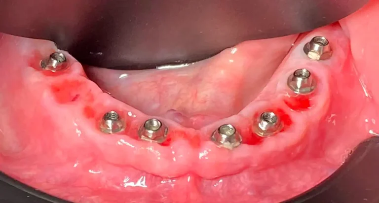 implantes 1