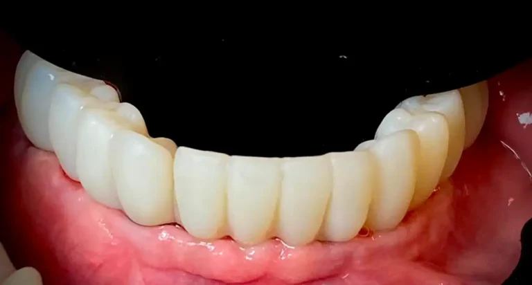 implantes 2